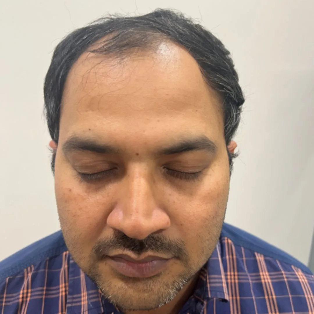 HAIR TRANSPLANT BEFORE