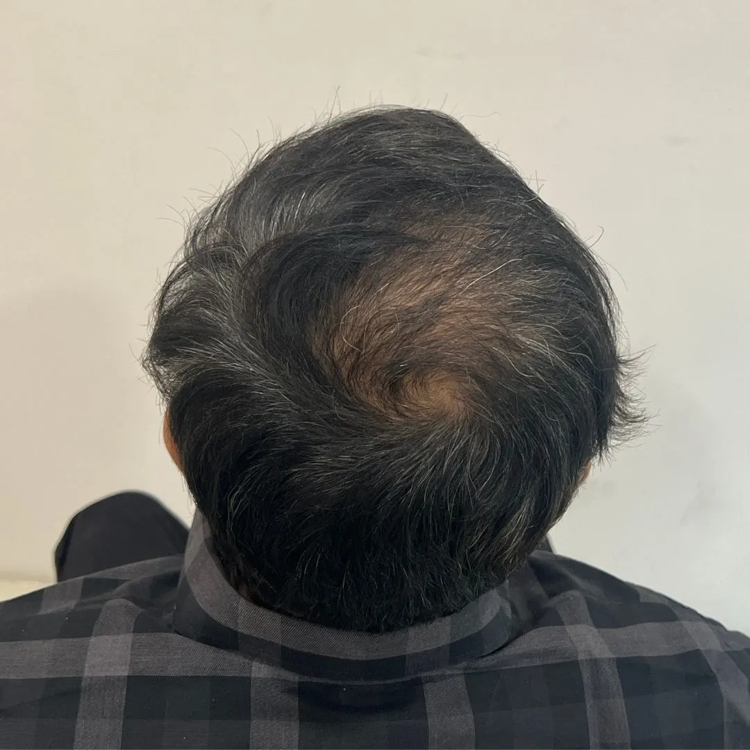 hair transplant after